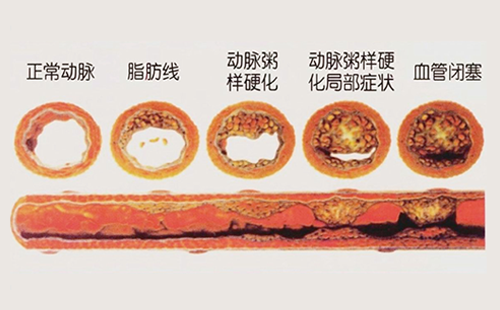 動(dòng)脈硬化檢測(cè)儀